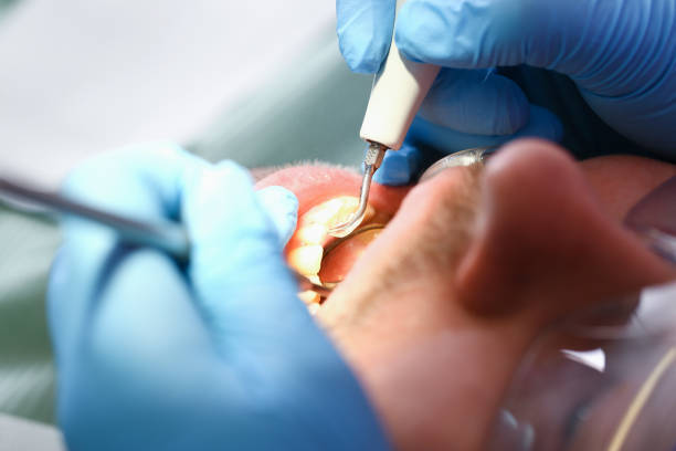 Best Emergency Dentist for Lost Fillings or Crowns in Canal Winchester, OH